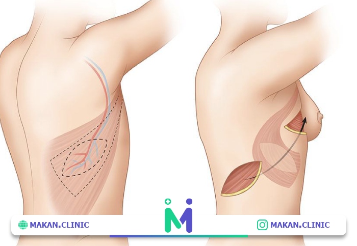 آیا ماستوپکسی برای همه مناسب است؟