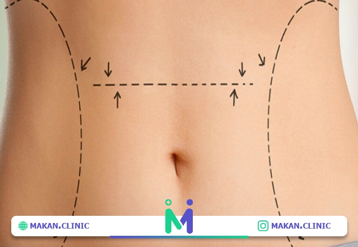 نقاهت عمل ابدومینوپلاستی