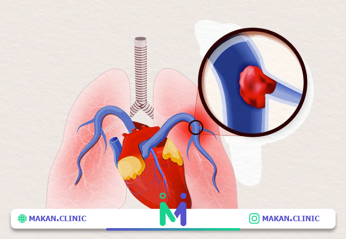 آمبولی بعد از عمل لیپوماتیک