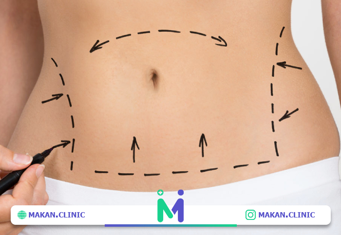 آیا انجام عمل ابدومینوپلاستی همزمان با سزارین توصیه می ‌شود؟