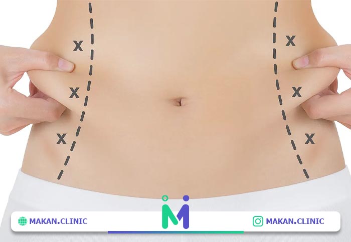 مراقبت های پس از جراحی لیپوماتیک