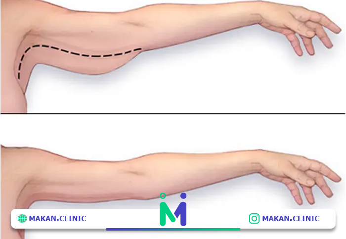 عمل لیپوماتیک بازو
