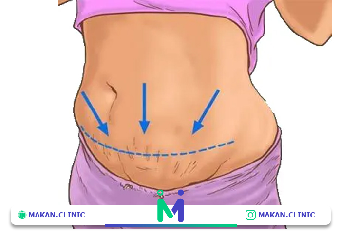 جراحی مینی ابدومینوپلاستی