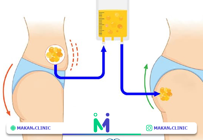 لیپوماتیک و تزریق چربی