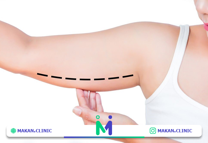 عمل لیپوماتیک بازو