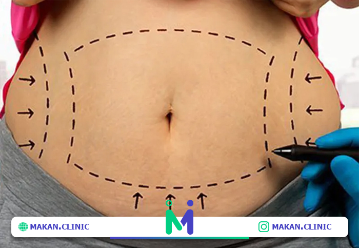 جراحی زیبایی شکم در مردان