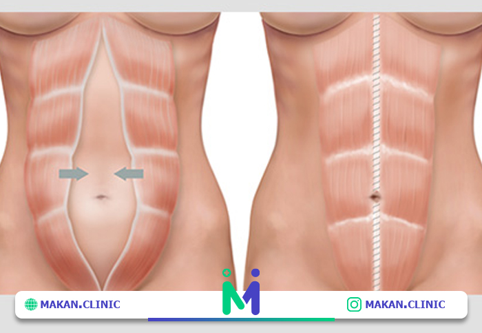 بهترین روش های جراحی زیبایی شکم