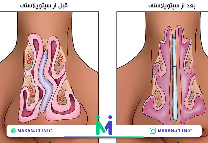 سپتوپلاستی چیست