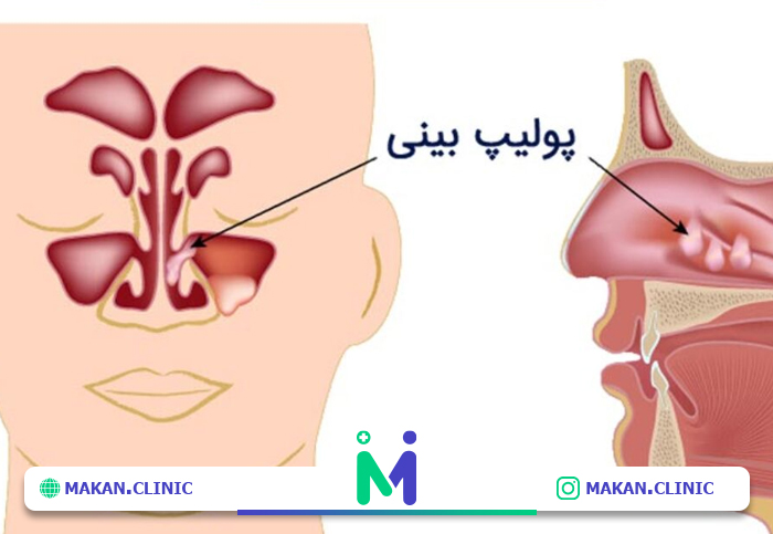 درمان پولیپ بینی