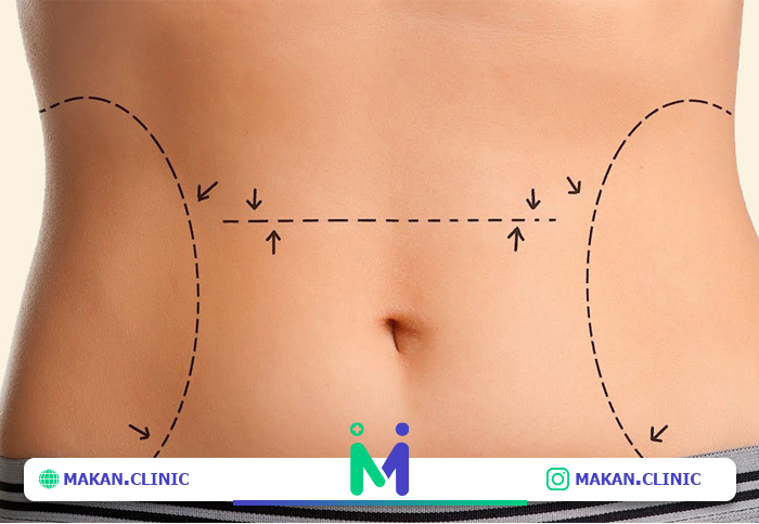 عوارض ابدومینوپلاستی