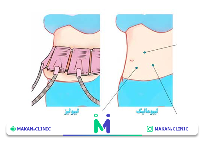 تفاوت لیپولیز و جراحی زیبایی شکم