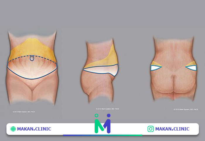 هزینه ابدومینوپلاستی